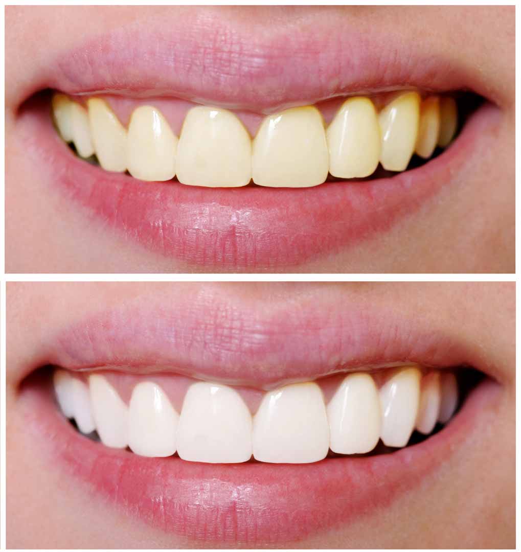 Teeth whitening services 
