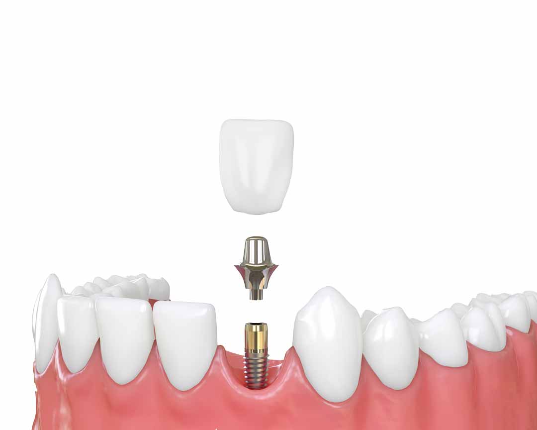 dental implants | Monument CO